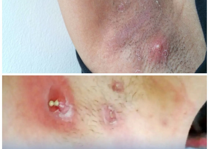 Penyebab Bisul di Ketiak yang Sering Terabaikan dan Cara Mengatasinya