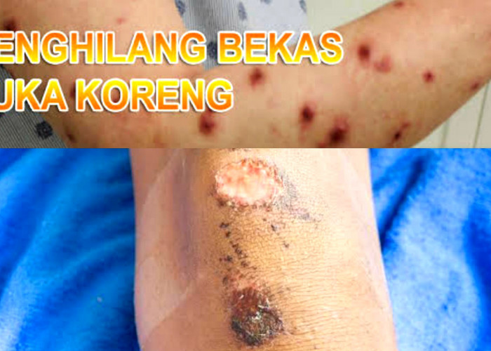 3 Bahan Ampuh Hilangkan Bekas Koreng dan Borok yang Menghitam