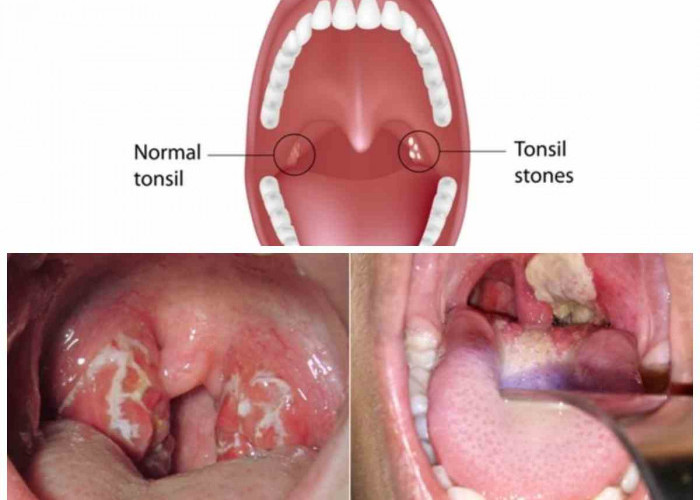 Tenggorokan Sering Terasa Tidak Nyaman? Kenali Ciri-Ciri dan Cara Mengatasi Batu Amandel