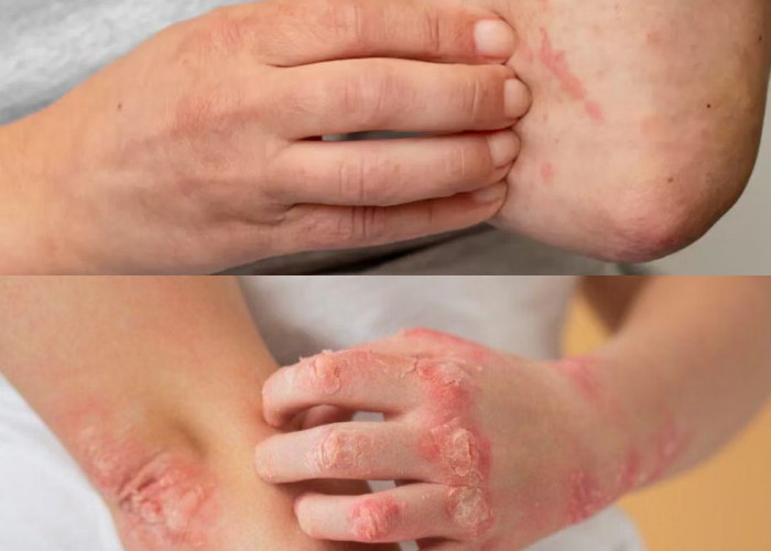 Yuk Wajib Anda Ketahui! Gigitan Kutu Kucing pada Manusia, Pahami Tanda dan Solusi Menghadapinya