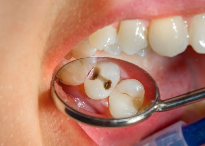 Waspada! Kamu Harus Tau, Inilah Penyebab dan Cara Mengatasi Sakit Gigi yang tak Kunjung Sembuh 