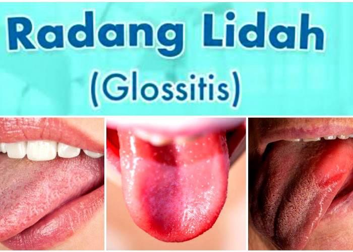 Penanganan Tepat Radang Lidah atau Glositis