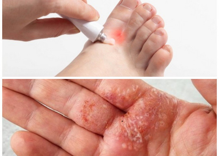 Panduan Lengkap Mengobati Kutu Air dan Strategi Pencegahan Efektif