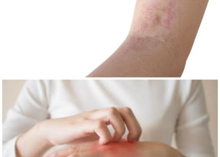 7 Tanda Kurap Mulai Sembuh yang Perlu Kamu Ketahui