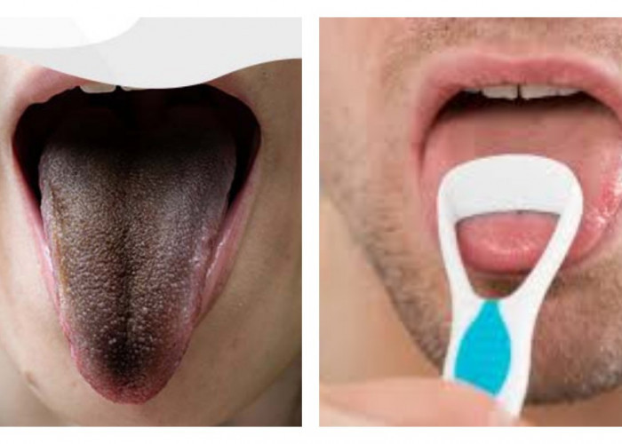 5 Penyebab Lidah Tampak Hitam dan Berbulu
