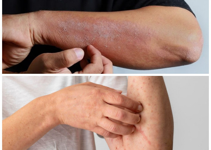 Jangan Diabaikan, Ini 8 Penyebab Kulit Kering dan Gatal yang Berkaitan dengan Kesehatan