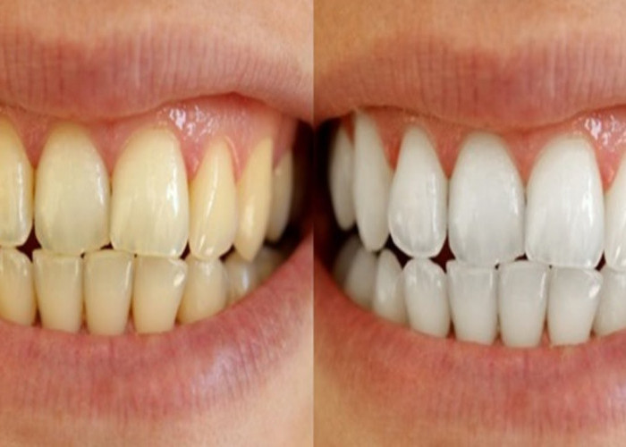 Selamat Tinggal Gigi Kuning! 5 Bahan Alami Ini Ampuh Putihkan Gigi