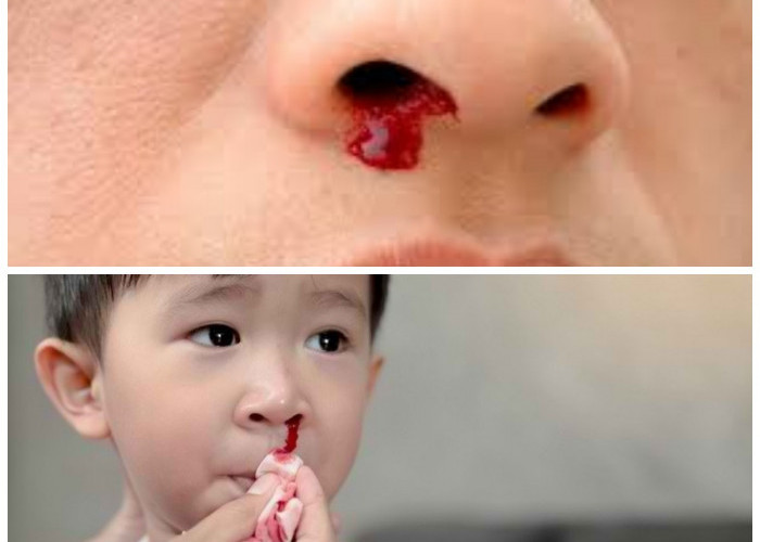 Atasi Mimisan dengan Tepat: Tips Praktis untuk Mengurangi Risiko Terulang