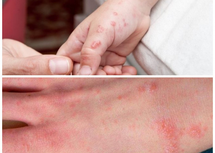 Kulit Terinfeksi Bakteri? Ini 5 Jenis Umum dan Cara Efektif Mengatasinya