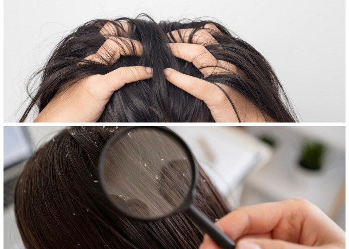Sering Disamakan, Ini Perbedaan Ketombe dan Dermatitis Seboroik yang Perlu Diketahui