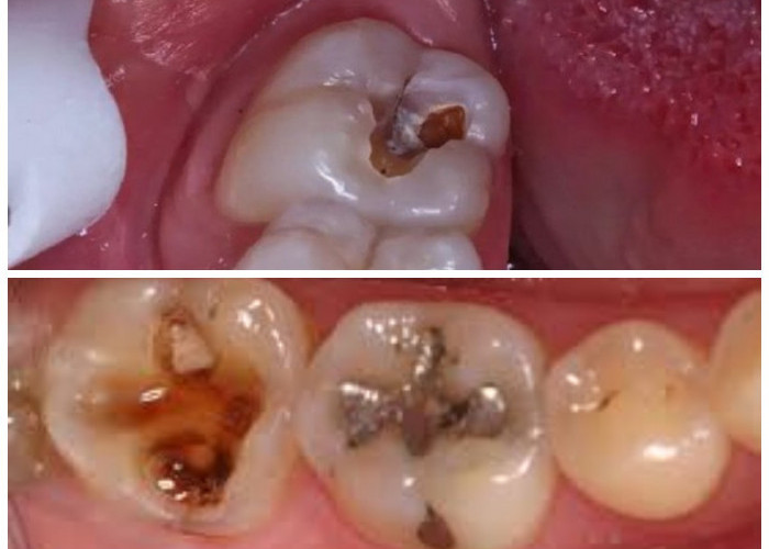 Rahasia Mengembalikan Kesehatan Gigi Berlubang dengan Bahan Alami di Rumah!