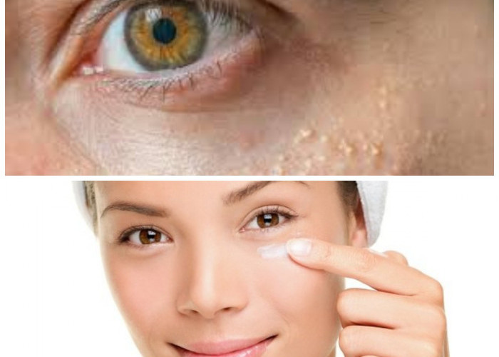 Solusi Alami Atasi Bintik Putih di Bawah Mata: Praktis dan Aman