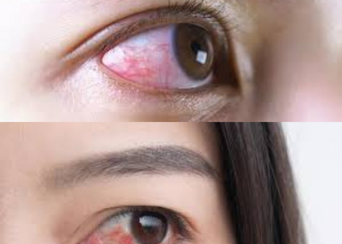 Begini 7 Metode Efektif untuk Menangani Mata Merah!