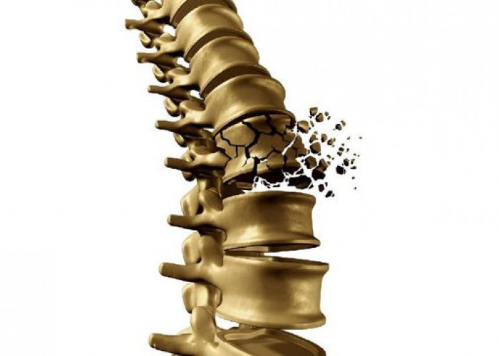 Kenali 7 Penyebab Penyakit Osteoporosis Sebelum Terlambat