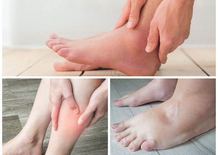 Kaki Bengkak: Kenali Penyebabnya dan Cara Efektif Menghilangkannya di Rumah!