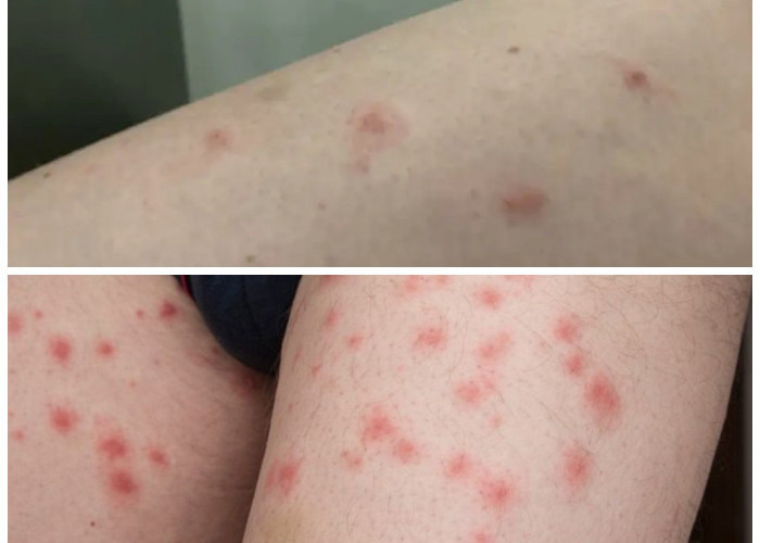 Tungau Kasur dan Risiko Kesehatannya: Cara Mendeteksi dan Mengatasi Gigitan