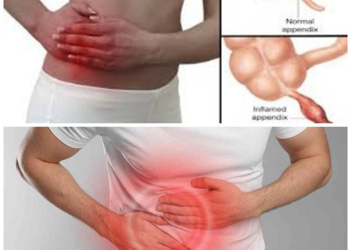Wajib Tahu! Usus buntu biasanya diobati dengan operasi. 