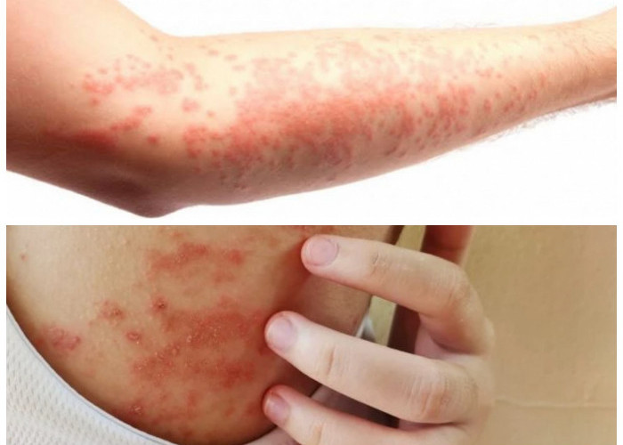 Wajib Tahu! 7 Jenis Penyakit Kulit Beserta Cara Mengatasinya Secara Tepat