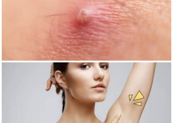 Sangat Mengganggu Aktivitas, Ini Cara Ampuh Atasi Bisul di Ketiak Memanfaatkan Bahan Obat Rumahan!