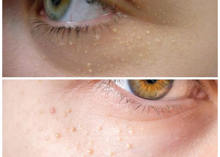 Bintik Putih di Sekitar Mata? Ini Cara Aman dan Efektif Mengatasinya