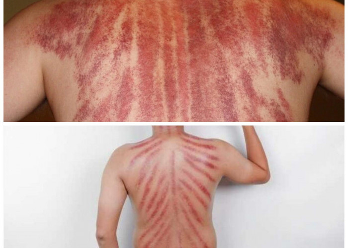 Manfaat Kerokan untuk Tubuh: Bikin Badan Lebih Ringan dan Segar!