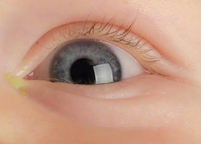 Bunda! Inilah Tips Menyembuhkan Mata Belekan Pada Bayi