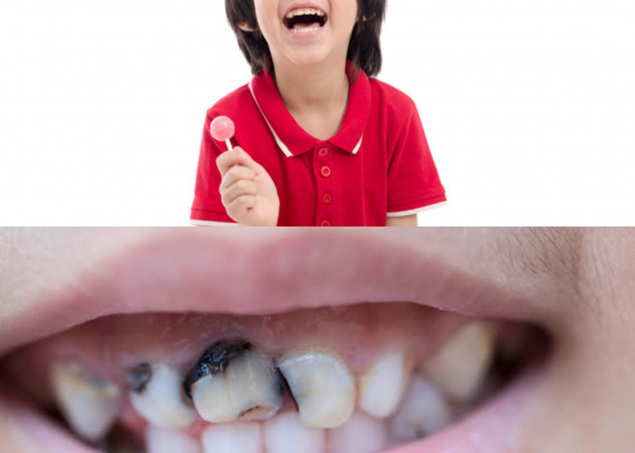Ternyata Ini Kebiasaan Utama yang Paling Sering Membuat Gigi Anak Cepat Berlubang