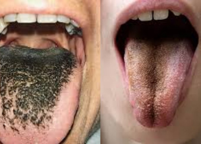  Lidah Menghitam dan Berbulu? Kok Bisa Sih, Simak 6 Penyebab dan Cara Mengatasinya!