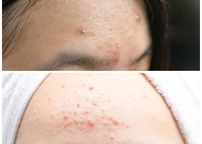 Cara Ampuh Atasi Jerawat di Jidat: Kenali Penyebab dan Tips Menghilangkannya