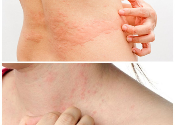 Kulit Gatal dan Ruam Setelah Konsumsi Daging Merah? Waspadai Alerginya dan Simak Cara Mengatasinya!