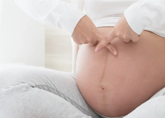 Pahami Lebih Jelas Tentang Linea Nigra atau Garis Memanjang pada Perut Ibu Hamil
