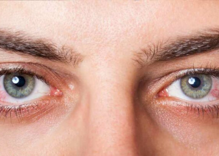 Kamu Harus Tau Penyebab Mata Buram yang Mempengaruhi Penglihatan 