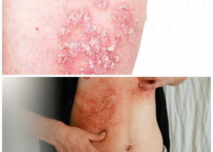 Jangan Abaikan! Ini 7 Penyakit Kulit yang Sering Terjadi dan Cara Penanganannya