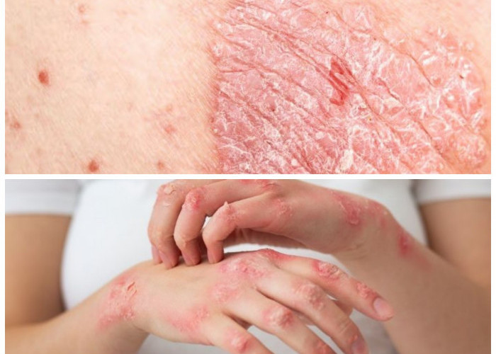  Waspadai! Ini 6 Penyakit Kulit yang Sering Terjadi dan Cara Tepat Mengatasinya