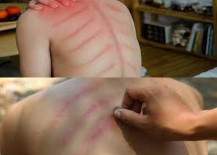 Ini Alasan Tubuh Lebih Segar Setelah Kerokan!