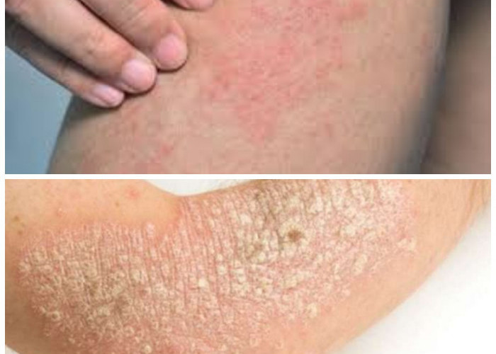 Waspada! Kulit Kering dan Gatal Bisa Menjadi Sinyal 8 Penyakit Serius Ini