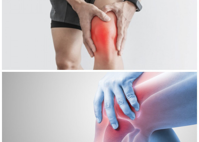 Mudah Ditemukan! Berikut 7 Obat Nyeri Lutut yang Efektif dan Menyembuhkan 