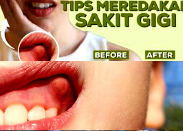 Ngga Pake Lama! Penyebab dan Atasi Gusi Bengkak Berdarah