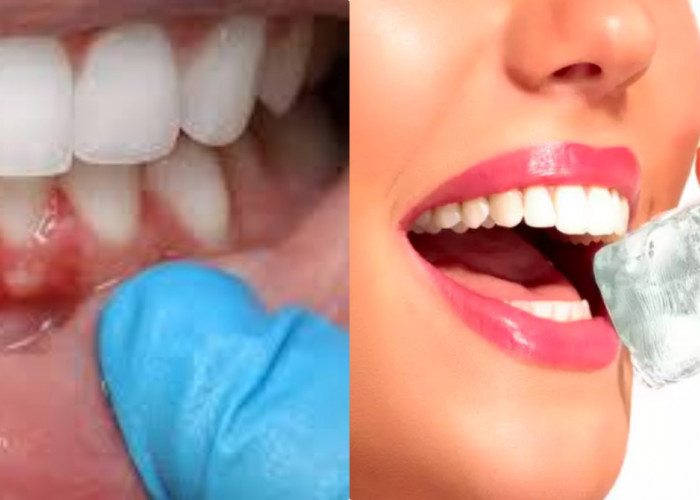 5 Faktor Penyebab Gusi Berdarah dan Solusinya