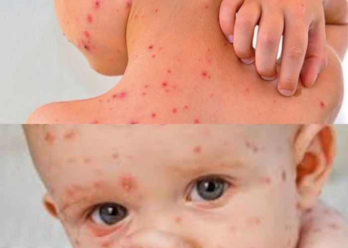 Ciri-Ciri Cacar Air yang Perlu Dikenali dan Diwaspadai!