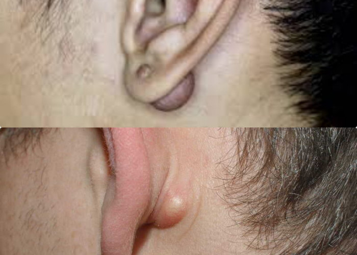4 Metode untuk Mengatasi Benjolan di Belakang Telinga