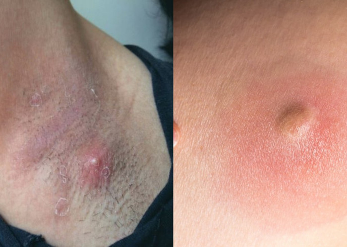 Perlu Dipelajari Penyebab Bisul di Ketiak dan Cara Mengatasinya!