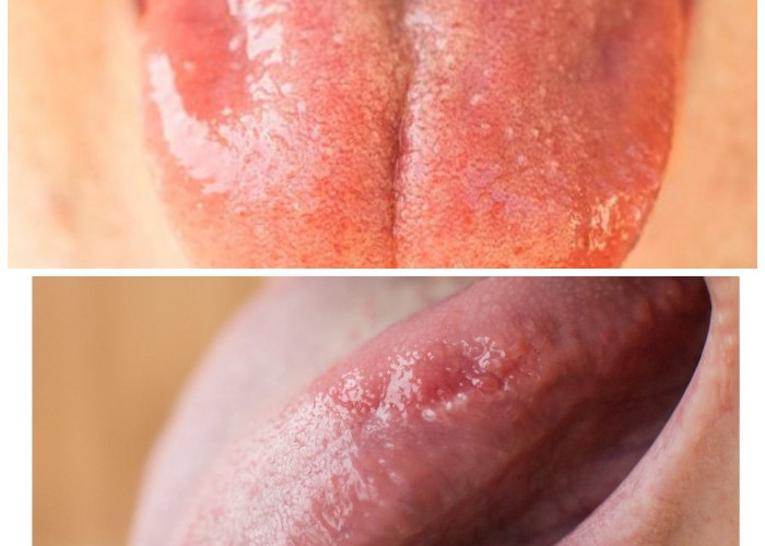 Cara Alami Atasi Radang Lidah: Redakan Nyeri dan Peradangan dengan Mudah