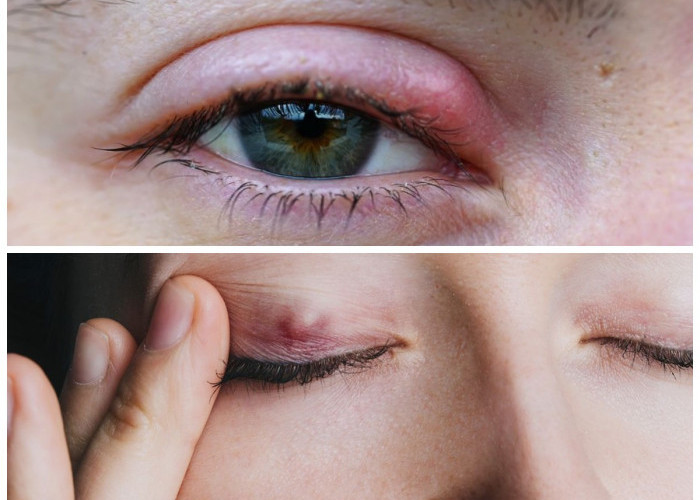 Kenali Benjolan di Bagian Dalam Mata serta Tips Pencegahannya