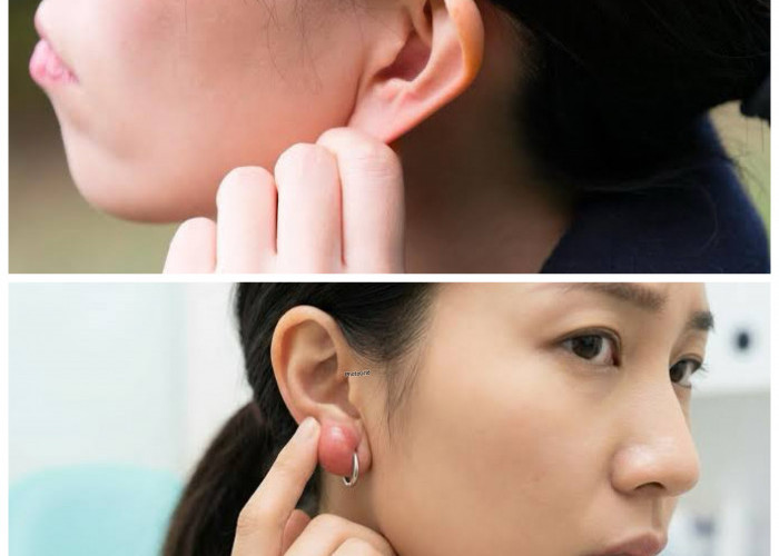 Kenapa Muncul Benjolan di Daun Telinga? Ini Penyebab dan Cara Mengatasinya!