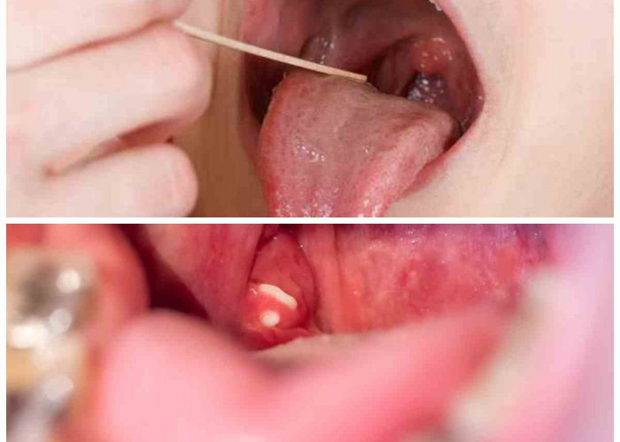 Waspadai! Sakit Tenggorokan Berulang Bisa Jadi Gejala Batu Amandel