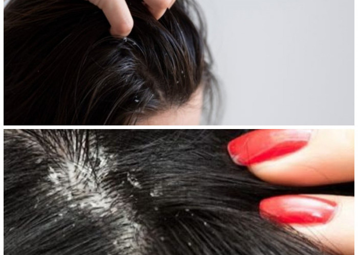 Cara Ampuh Menghilangkan Ketombe: 7 Tips yang Wajib Dicoba