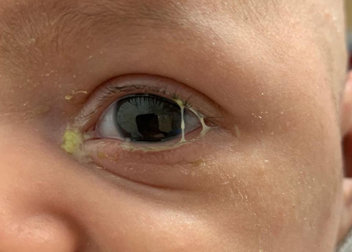 Mata Bayi Sering Belekan? Ikuti Cara Ini untuk Menanganinya 