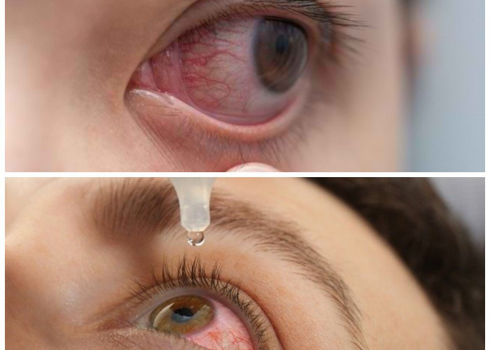 Tips Ampuh Atasi Mata Merah Akibat Debu dan Polusi