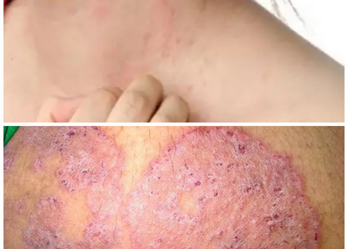 Gejala Alergi Jamur dan Solusi Pengobatannya: Panduan Lengkap untuk Hidup Lebih Sehat